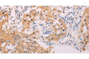 Immunohistochemistry of paraffin-embedded Human lung cancer tissue using ADHFE1 Polyclonal Antibody at dilution 1:30 (ADHFE1 抗体)
