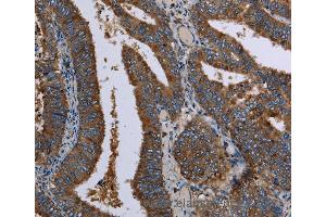 Immunohistochemistry of Human colon cancer using LZTFL1 Polyclonal Antibody at dilution of 1:30