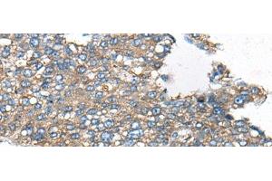 Immunohistochemistry of paraffin-embedded Human liver cancer tissue using CDC42BPA Polyclonal Antibody at dilution of 1:60(x200) (CDC42BPA 抗体)