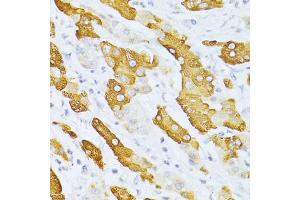 Immunohistochemistry of paraffin-embedded human liver cancer using CYP2E1 antibody (ABIN5971187) at dilution of 1/100 (40x lens). (CYP2E1 抗体)