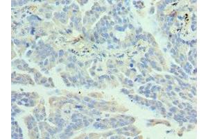 Immunohistochemistry of paraffin-embedded human lung cancer using ABIN7155475 at dilution of 1:100 (EZH1 抗体  (AA 160-280))