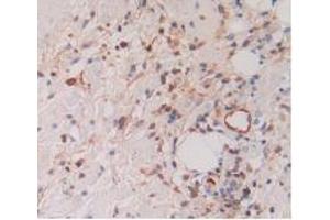 IHC-P analysis of Human Skin Cancer Tissue, with DAB staining.