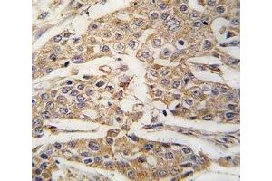 IHC analysis of FFPE human breast carcinoma tissue stained with PKM2 antibody (PKM2 抗体  (AA 460-489))