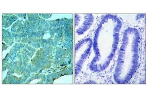 Immunohistochemical analysis of paraffin-embedded human colon carcinoma tissue using PKR(Phospho-Thr446) Antibody(left) or the same antibody preincubated with blocking peptide(right).