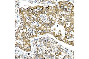 Immunohistochemistry of paraffin-embedded human lung cancer using Calumenin Rabbit mAb (ABIN7266050) at dilution of 1:25 (40x lens). (CALU 抗体)
