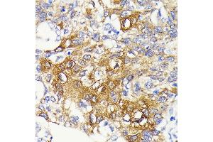 Immunohistochemistry of paraffin-embedded human lung cancer using IKKβ antibody (ABIN7267873) at dilution of 1:100 (40x lens). (IKBKB 抗体)