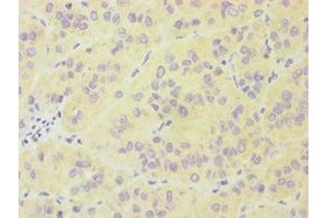 Immunohistochemistry of paraffin-embedded human liver cancer using ABIN7174019 at dilution of 1:100 (FES 抗体  (AA 120-420))