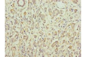 Immunohistochemistry of paraffin-embedded human pancreatic cancer using ABIN7152171 at dilution of 1:100 (Eukaryotic Translation Initiation Factor 3, Subunit M (EIF3M) (AA 1-374) 抗体)