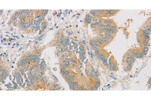 Immunohistochemistry of paraffin-embedded Human colon cancer tissue using ZWINT Polyclonal Antibody at dilution 1:50 (ZWINT 抗体)