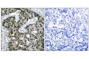 Immunohistochemical analysis of paraffin-embedded human breast carcinoma tissue using HSF1 (phospho- Ser303) antibody (E011263). (HSF1 抗体  (pSer303))