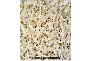 SGP Antibody (Center) (ABIN651464 and ABIN2840255) immunohistochemistry analysis in forlin fixed and paraffin embedded hun breast carcino followed by peroxidase conjugation of the secondary antibody and DAB staining. (SMAGP 抗体  (AA 46-75))