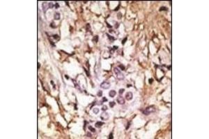 Formalin-fixed and paraffin-embedded human cancer tissue reacted with the primary antibody, which was peroxidase-conjugated to the secondary antibody, followed by DAB staining. (MAP1LC3A 抗体  (C-Term))