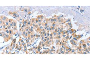 Immunohistochemistry of paraffin-embedded Human breast cancer using APOBEC3D Polyclonal Antibody at dilution of 1:80 (APOBEC3D 抗体)