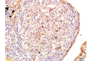 Formalin-fixed and paraffin embedded human lung carcinoma labeled with Anti-GRK6 Polyclonal Antibody, Unconjugated (ABIN1387719) at 1:200 followed by conjugation to the secondary antibody and DAB staining. (GRK4/GRK5/GRK6 (AA 181-280) 抗体)