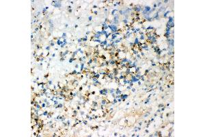 Anti- CD63 Picoband antibody, IHC(P) IHC(P): Human Intestinal Cancer Tissue (CD63 抗体  (AA 97-238))