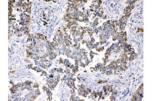 Periplakin was detected in paraffin-embedded sections of human lung cancer tissues using rabbit anti- Periplakin Antigen Affinity purified polyclonal antibody (Catalog # ) at 1 µg/mL. (PPL 抗体  (C-Term))