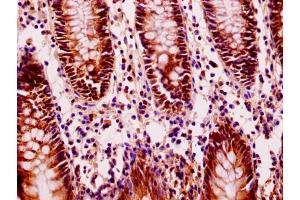 Immunohistochemistry of paraffin-embedded human colon cancer using ABIN7152940 at dilution of 1:100 (FIL1L 抗体  (AA 1-200))
