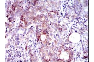 Immunohistochemical analysis of paraffin-embedded cervical cancer tissues using SLC27A5 mouse mAb with DAB staining. (SLC27A5 抗体  (AA 508-570))
