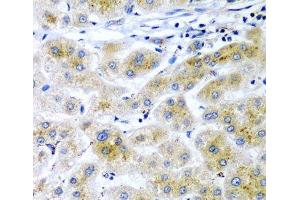 Immunohistochemistry of paraffin-embedded Human liver cancer using RARRES2 Polyclonal Antibody at dilution of 1:200 (40x lens). (Chemerin 抗体)