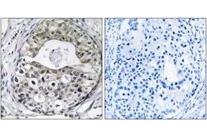 Immunohistochemistry analysis of paraffin-embedded human breast carcinoma tissue, using RPS13 Antibody. (RPS13 抗体  (AA 71-120))