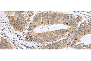 Immunohistochemistry of paraffin-embedded Human colorectal cancer tissue using MARCKSL1 Polyclonal Antibody at dilution of 1:50(x200) (MARCKSL1 抗体)