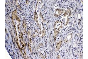 IHC testing of FFPE human rectal cancer tissue with MED4 antibody at 1ug/ml. (MED4 抗体)