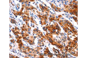 Immunohistochemistry of Human thyroid cancer using SEPT4 Polyclonal Antibody at dilution of 1:50 (Septin 4 抗体)