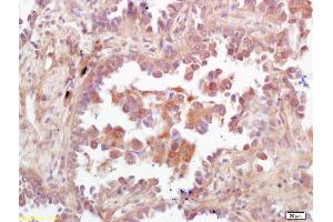 Formalin-fixed and paraffin embedded human lung carcinoma labeled with Rabbit Anti PBK/TOPK Polyclonal Antibody, Unconjugated (ABIN747608) at 1:200 followed by conjugation to the secondary antibody and DAB staining (PBK 抗体  (AA 251-322))