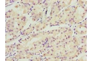 Immunohistochemistry of paraffin-embedded human gastric cancer using ABIN7175738 at dilution of 1:100