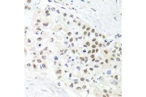 Immunohistochemistry of paraffin-embedded human lung cancer using TRMT1 antibody.