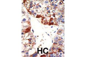 Formalin-fixed and paraffin-embedded human hepatocellular carcinoma tissue reacted with NUB1 polyclonal antibody  , which was peroxidase-conjugated to the secondary antibody, followed by DAB staining . (NUB1 抗体  (N-Term))