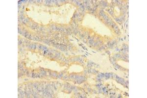 Immunohistochemistry of paraffin-embedded human endometrial cancer using ABIN7165861 at dilution of 1:100 (NIPSNAP3B 抗体  (AA 1-247))