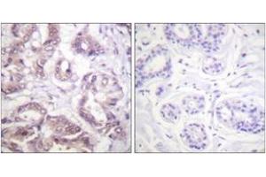 Immunohistochemistry analysis of paraffin-embedded human breast carcinoma tissue, using Survivin (Ab-34) Antibody. (Survivin 抗体  (AA 11-60))