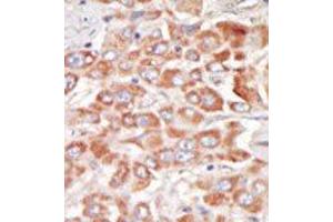 Formalin-fixed and paraffin-embedded human cancer tissue reacted with the primary antibody, which was peroxidase-conjugated to the secondary antibody, followed by DAB staining. (SRPK3 抗体  (Middle Region))