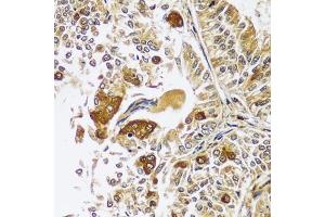 Immunohistochemistry of paraffin-embedded human uterine cancer using CAST antibody  at dilution of 1:100 (40x lens). (Calpastatin 抗体  (AA 1-350))