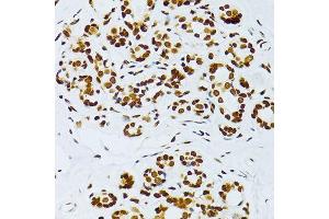 Immunohistochemistry of paraffin-embedded human breast using Phospho-RELA-S276 antibody (ABIN6003884) at dilution of 1/100 (40x lens). (NF-kB p65 抗体  (pSer276))