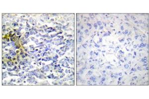 Immunohistochemistry analysis of paraffin-embedded human lung carcinoma tissue using FXR2 antibody. (FXR2 抗体  (C-Term))