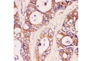 Anti-MyD88 Picoband antibody,  IHC(P): Human Intestinal Cancer Tissue (MYD88 抗体  (AA 44-264))