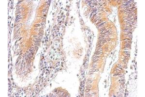 IHC-P Image AMPK gamma 2 antibody detects PRKAG2 protein at cytosol on human gastric cancer by immunohistochemical analysis. (PRKAG2 抗体  (full length))