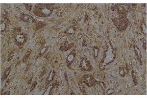 Immunohistochemistry of paraffin-embedded Human breast carcinoma tissue with Phosphoserine Monoclonal Antibody at dilution of 1:200 (Phosphoserine 抗体)