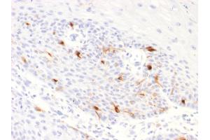 Formalin-fixed, paraffin-embedded human Basal Cell Carcinoma stained with TYRP1 Recombinant Rabbit Monoclonal Antibody (TYRP1/2340R). (Recombinant Tyrosinase-Related Protein 1 抗体  (AA 257-377))