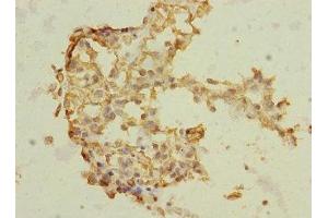Immunohistochemistry of paraffin-embedded human breast cancer using ABIN7172186 at dilution of 1:100 (TRHDE 抗体  (AA 62-200))