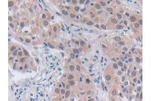 DAB staining on IHC-P; Samples: Human Lung cancer Tissue (SRY 抗体  (AA 1-204))