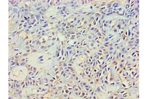 Immunohistochemistry of paraffin-embedded human breast cancer using ABIN7149353 at dilution of 1:100 (NCK2 抗体  (AA 1-380))
