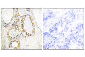 Immunohistochemistry analysis of paraffin-embedded human colon carcinoma tissue using Mucin 13 antibody. (MUC13 抗体  (C-Term))