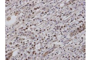 IHC-P Image Immunohistochemical analysis of paraffin-embedded human gastric cancer, using EAR2 , antibody at 1:100 dilution. (NR2F6 抗体  (C-Term))