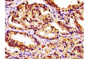 IHC image of ABIN7146424 diluted at 1:100 and staining in paraffin-embedded human prostate cancer performed on a Leica BondTM system. (CAMKK2 抗体  (AA 5-148))