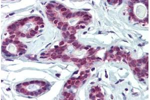 Human Breast (formalin-fixed, paraffin-embedded) stained with FUBP1 antibody ABIN462199 followed by biotinylated goat anti-rabbit IgG secondary antibody ABIN481713, alkaline phosphatase-streptavidin and chromogen. (FUBP1 抗体  (AA 540-589))