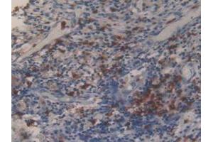 IHC-P analysis of Human Lung Cancer Tissue, with DAB staining. (MMP 9 抗体  (AA 213-399))