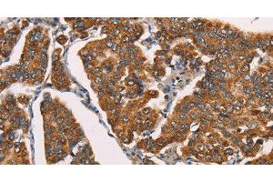 Immunohistochemistry of paraffin-embedded Human breast cancer using SPR Polyclonal Antibody at dilution of 1:40 (SPR 抗体)